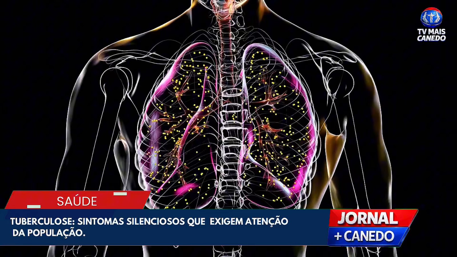 Senador Canedo oferece diagnóstico e tratamento gratuito para combater a tuberculose pelo SUS